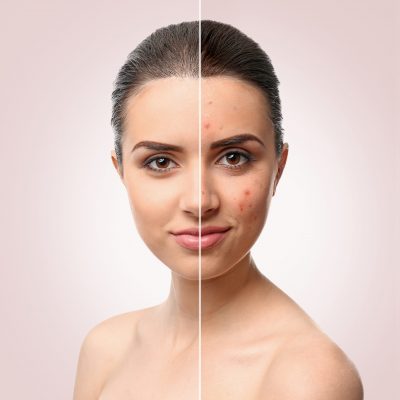 before and after acne treatment