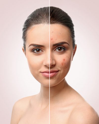 before and after acne treatment