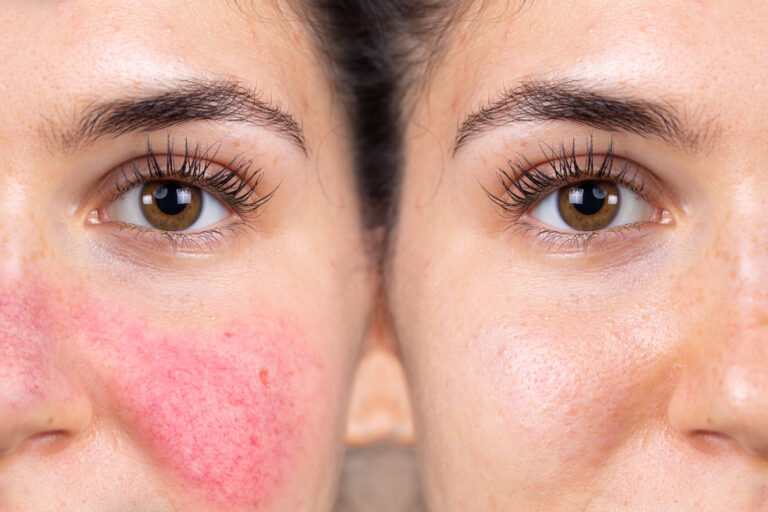 How Can a Sensitive Skin Treatment Help With Rosacea