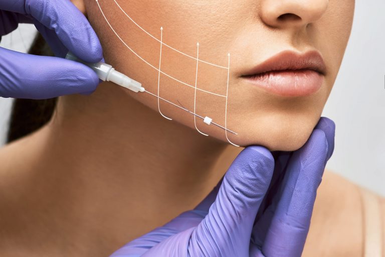 Facial lifting thread thread lift