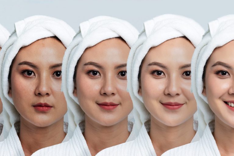 hyperpigmentation hyperpigmentation